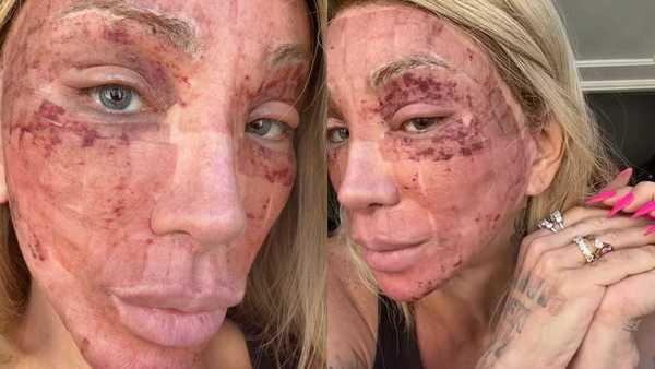 Maya Massafera mostra piora pós-peeling: 'Quanto mais incho, melhor'