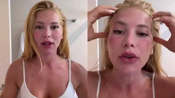 Virginia Fonseca aparece com rosto inchado após Xerf e Ultrapulse; conheça