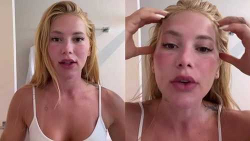 Virginia Fonseca aparece com rosto inchado após Xerf e Ultrapulse; conheça