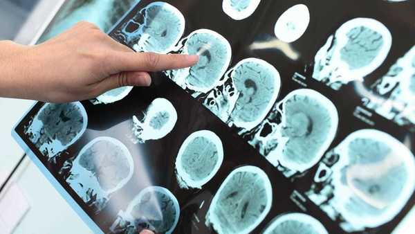 Veja fatores de risco que podem acelerar a demência
