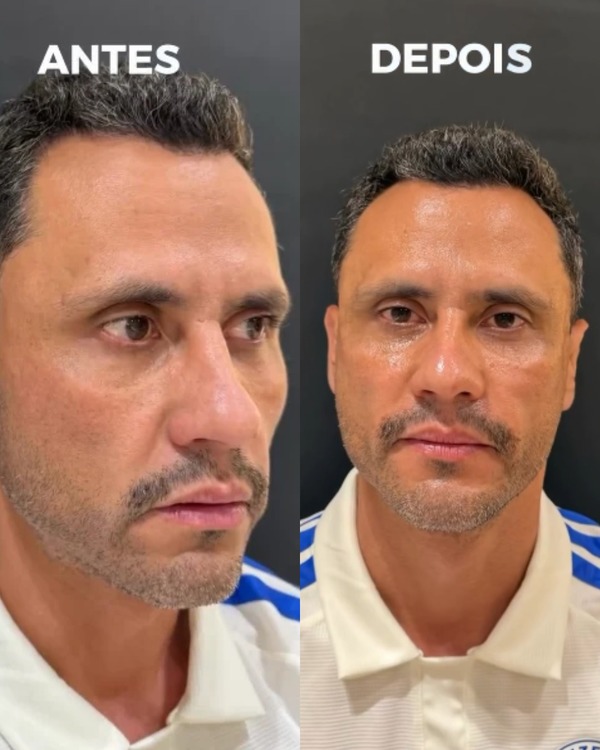 Após ser eleito governador de MG, Cleitinho faz harmonização facial