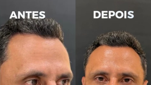 Após ser eleito governador de MG, Cleitinho faz harmonização facial