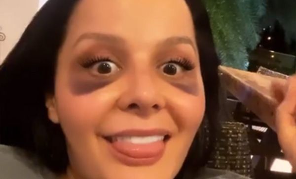 Maraisa passa por cirurgia plástica e aparece com olhos roxos nas redes sociais