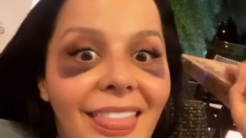 Maraisa passa por cirurgia plástica e aparece com olhos roxos nas redes sociais